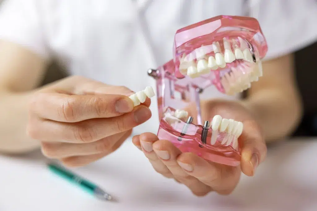 Dental implant model showing replacement teeth and implant placement