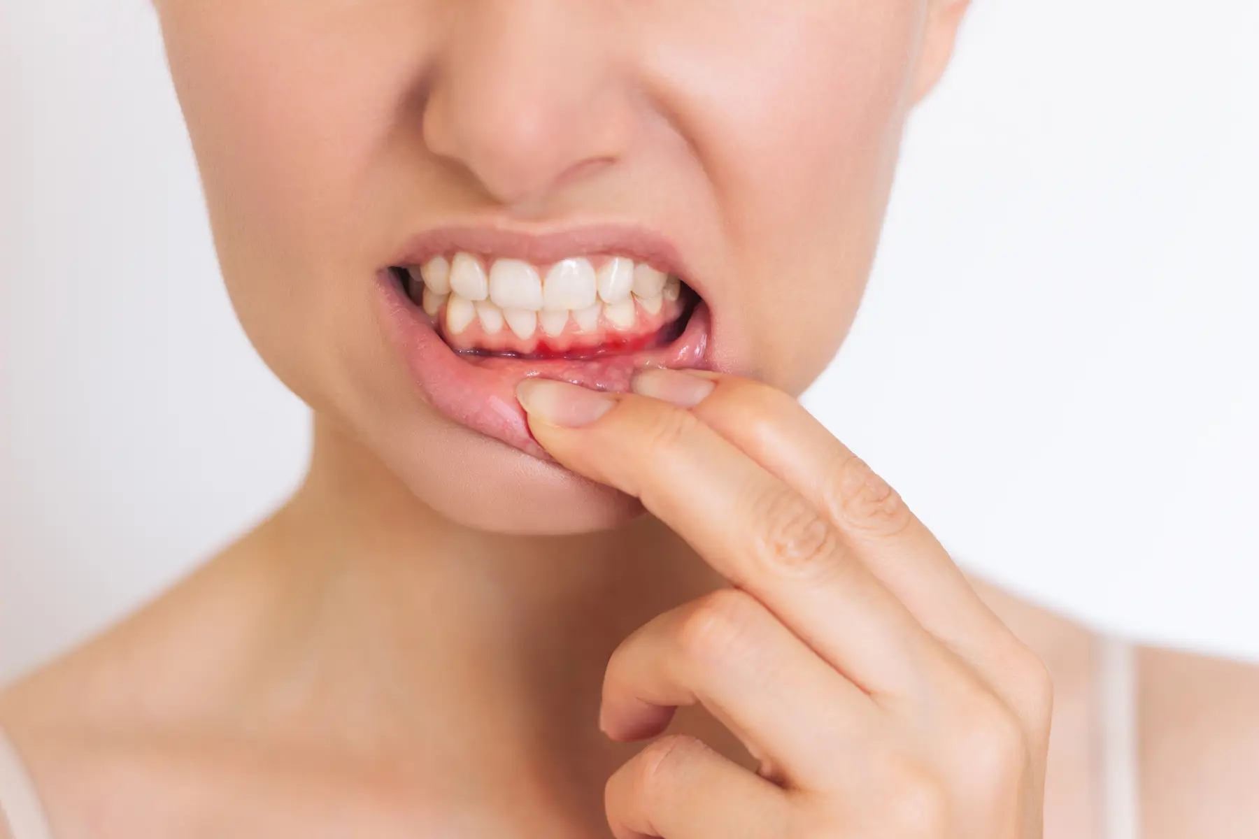 Periodontal (Gum) Disease in New Brighton & Fridley, MN