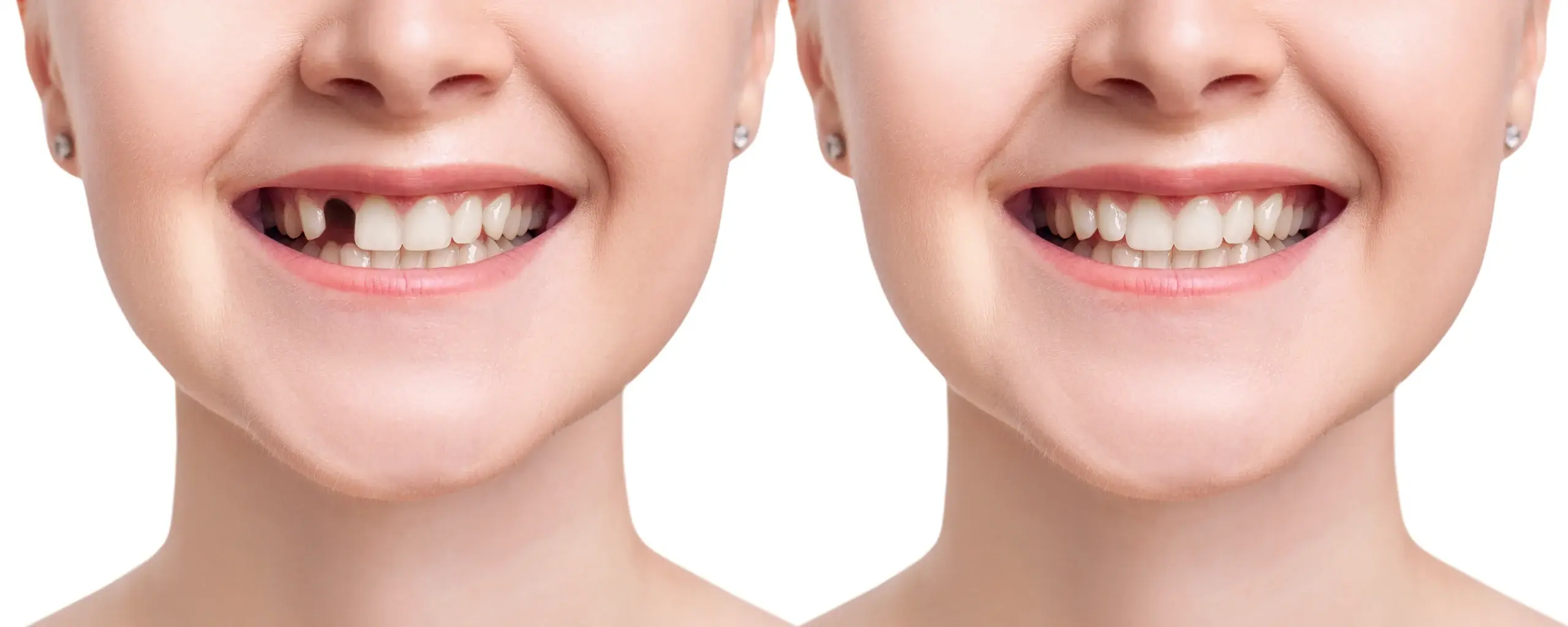 Parkside Dental for Dental Implants in New Brighton & Fridley, MN